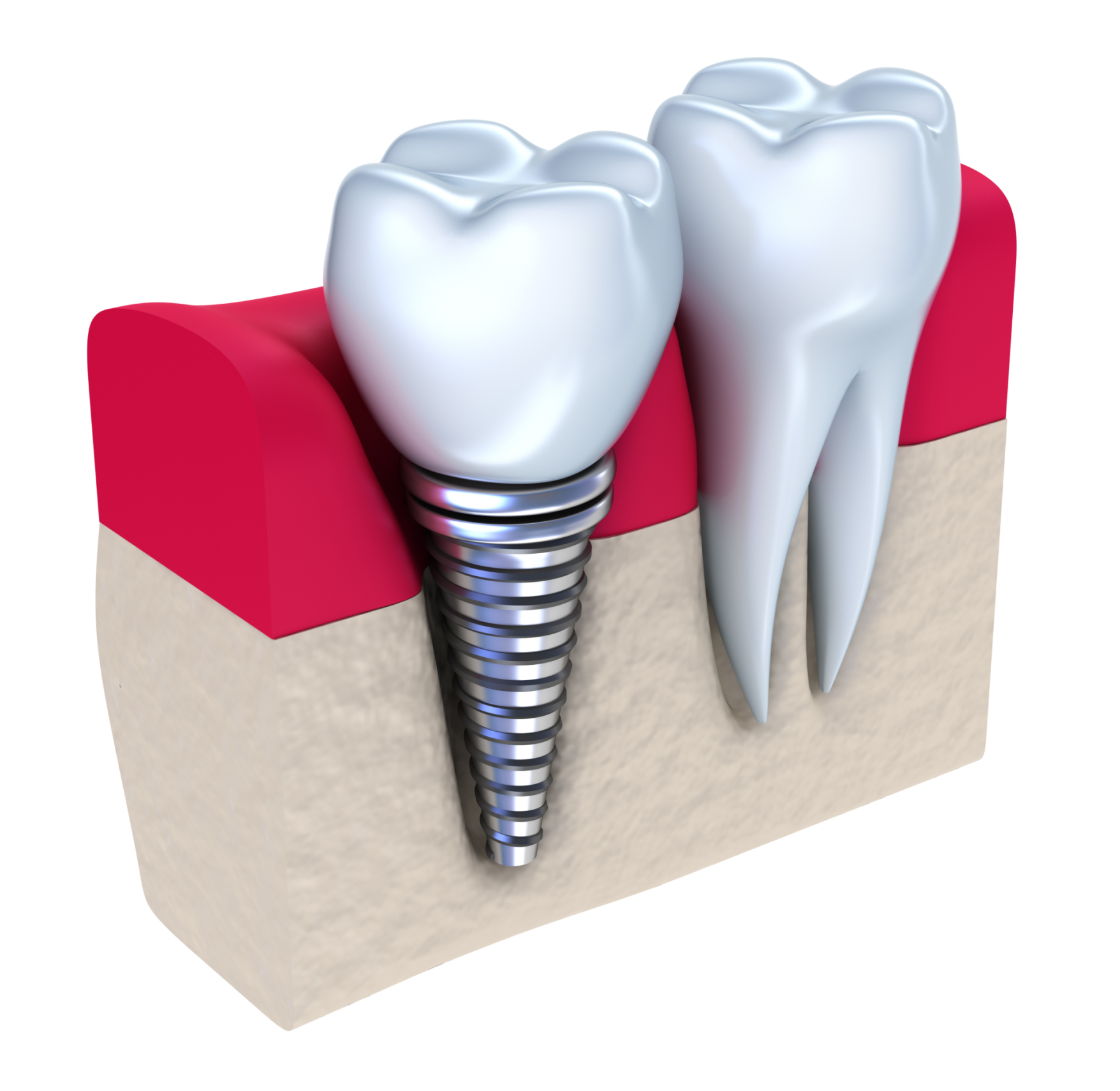 Зуба без рекламы. Имплантация зубов Dental implan. Осстем имплант. Имплантация Osstem. Имплант Osstem Южная Корея.