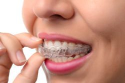 Woman wearing orthodontic silicone trainer