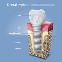 3 reasons to replace missing teeth with dental implants nixa mo