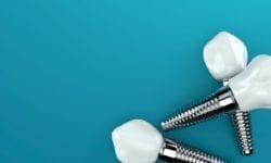 caring for dental implants nixa mo