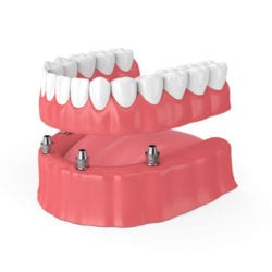 implant secured dentures nixa