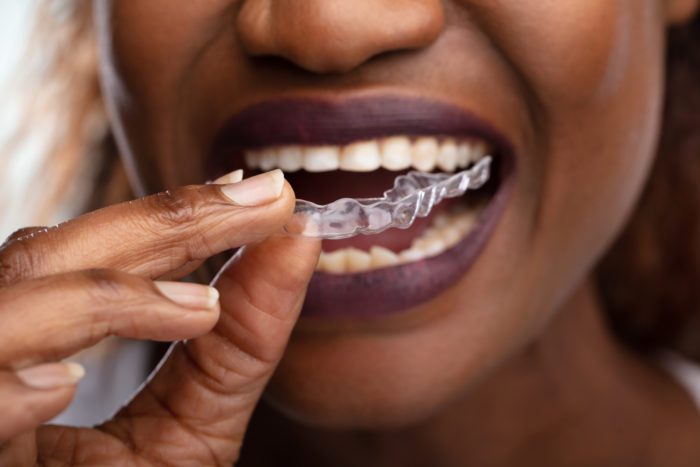 Benefits of Invisalign in Nixa, Missouri