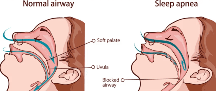 image of normal airway compared to obstructed airway from sleep apnea dentist in Nixa Missouri