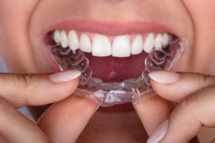 Woman placing clear aligners into mouth invisalign dentist in Nixa Missouri